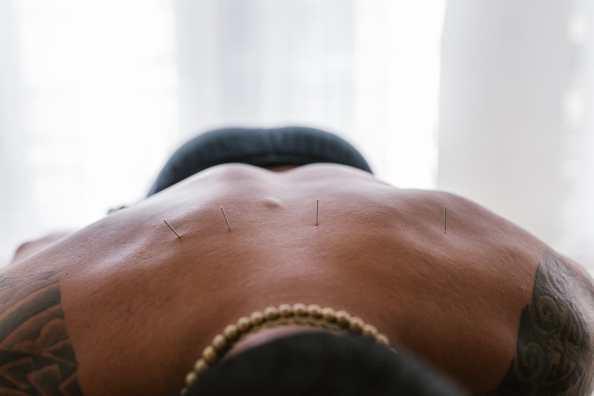 Fine acupuncture needles placed along a person's upper back